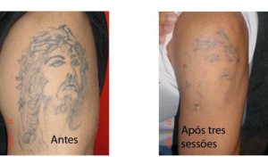 Algumas tatuagens não pode ser removidas.